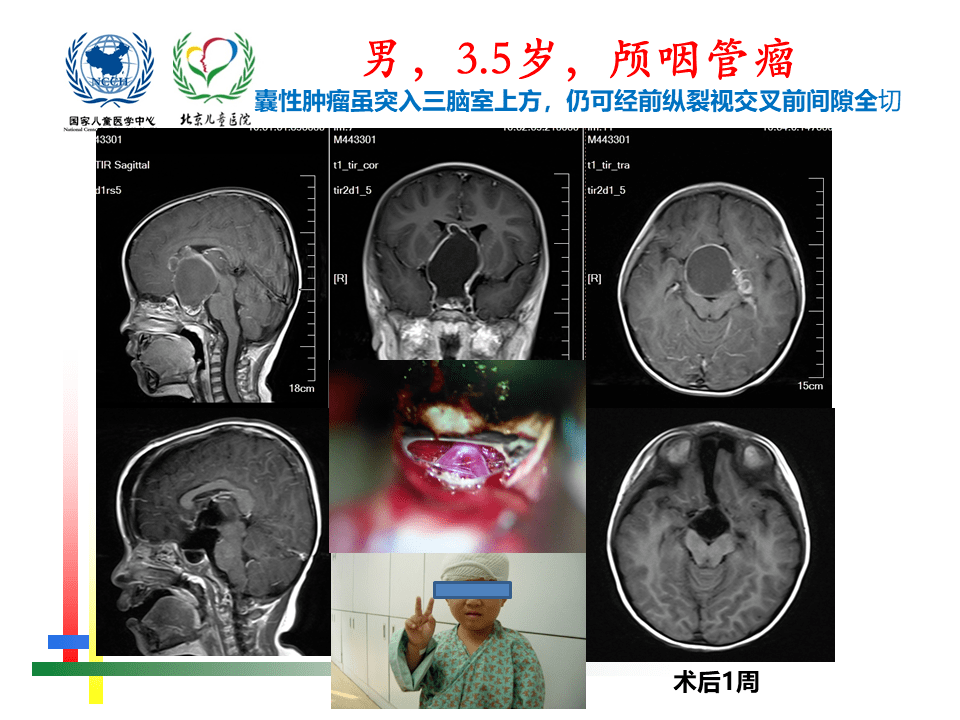 解剖课件 儿童鞍区肿瘤常见手术入路 北京儿童医院葛明