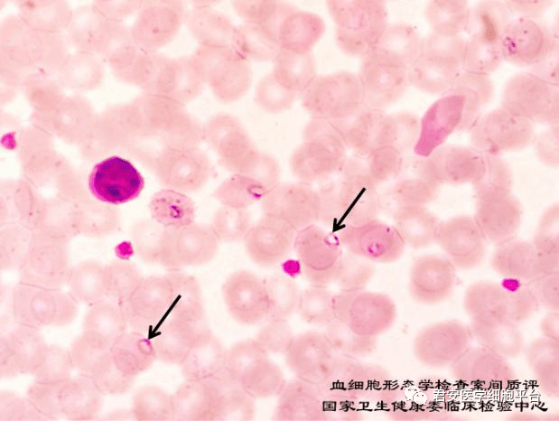 苏木素小体图片