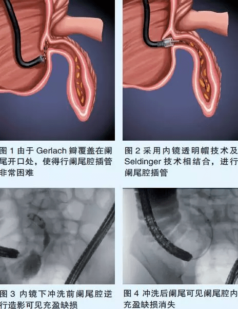 2,阑尾能分泌激素;1,阑尾是一个免疫器官;阑尾的功能:阑尾是有用的,能