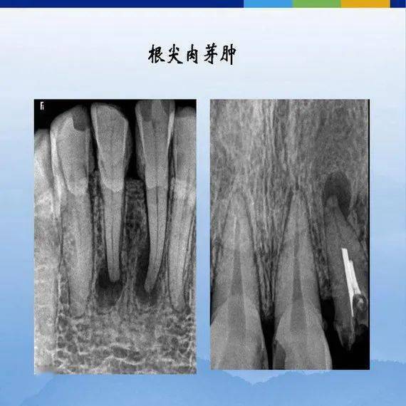 牙体牙周正常解剖及常见病x线表现