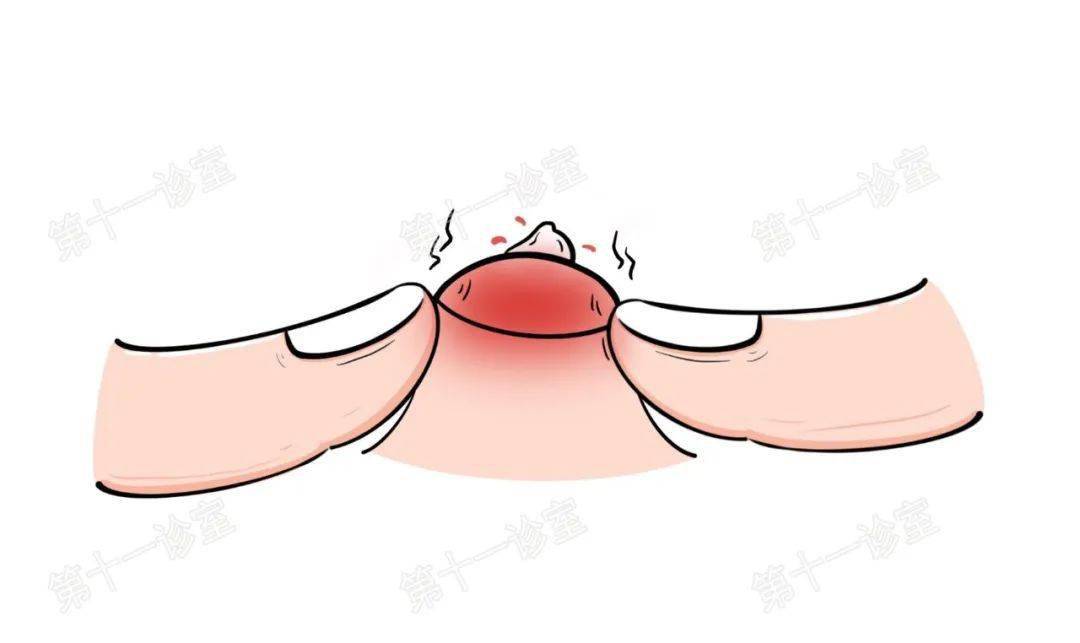 挤痘痘(前方高能预警,请做好准备.