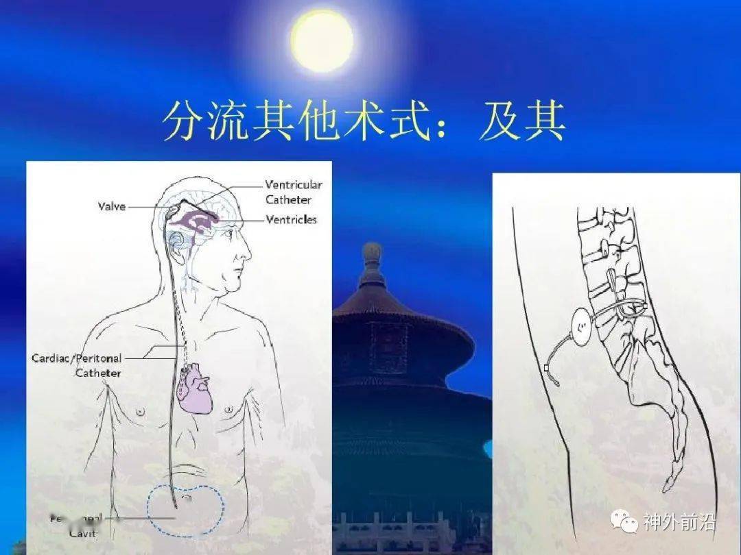 实用课件 脑积水及分流术后并发症