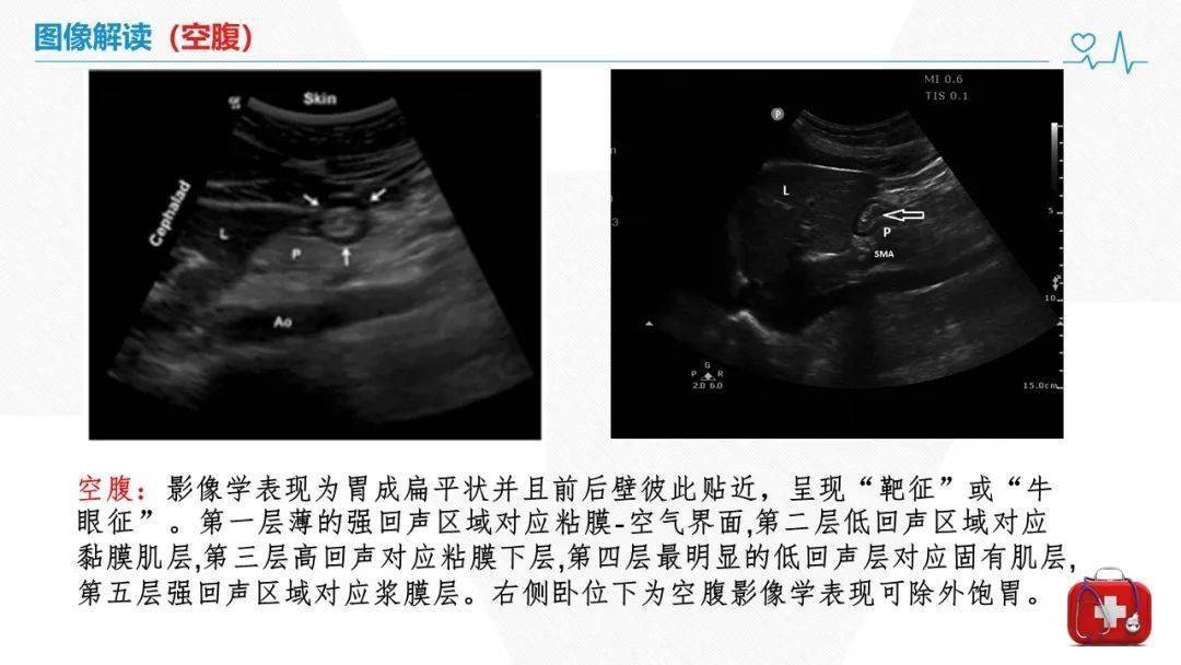 胃壁超声声像图分几层图片