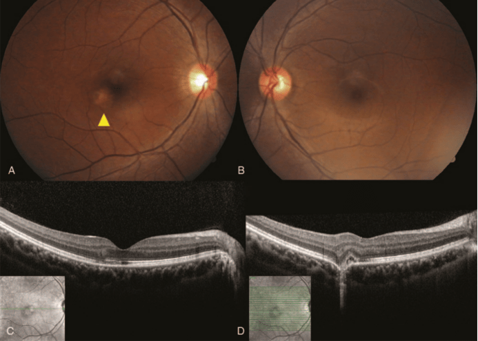 荧光造影提示渗漏,oct上可以看到视网膜色素上皮断裂及中心凹处光感受