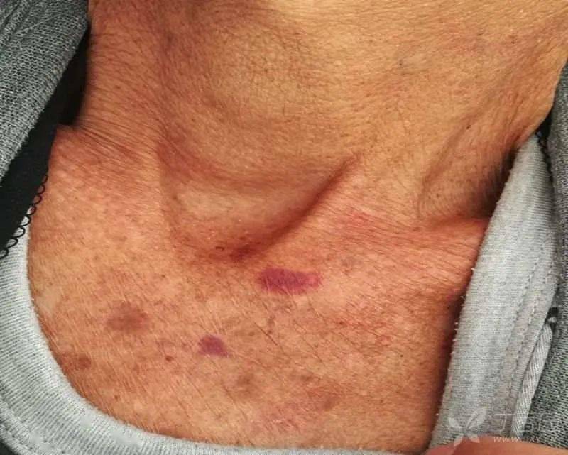 戒酒6 年后突发肝功能异常?呕血,黑便,全身多脏器系统损害