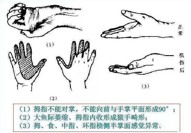 体育生必须了解的运动损伤及关节损伤处理原则