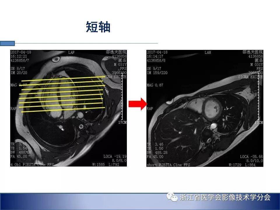 心臟磁共振掃描技術要點及偽影控制策略