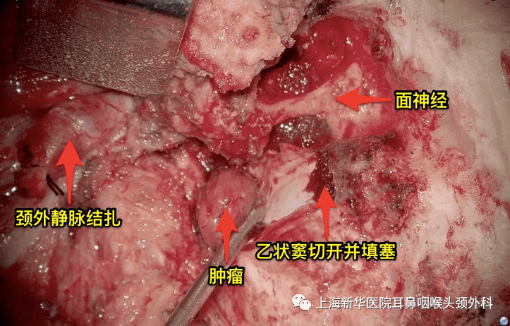 不移位面神經的顳下窩a型徑路切除頸靜脈球頸動脈體副神經節瘤