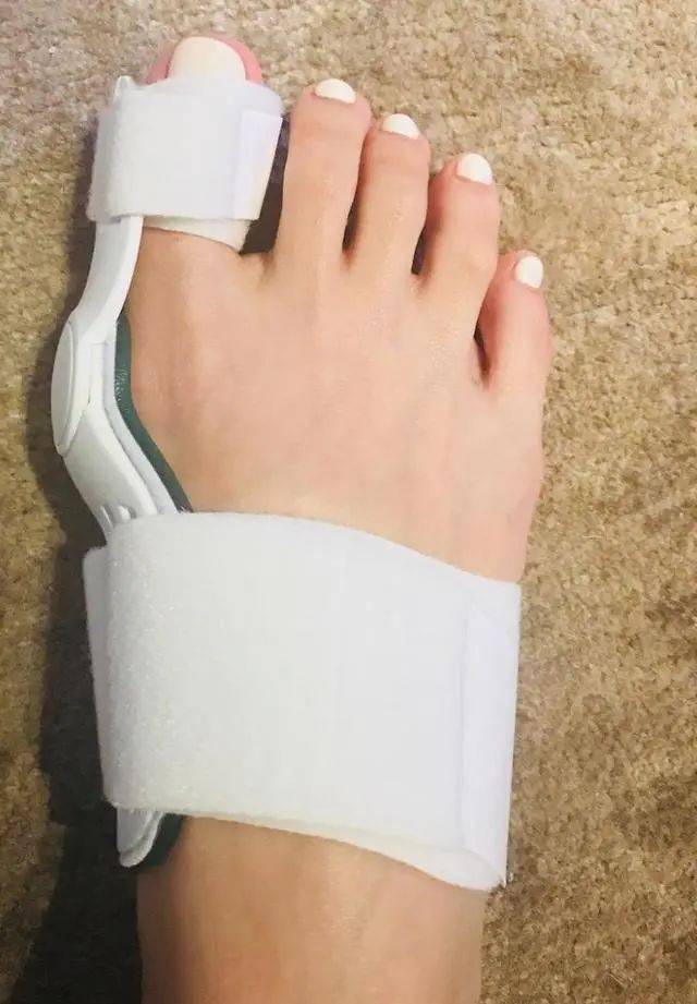 宋茜脚趾外翻好尴尬恨天高这玩意儿还是悠着点穿吧