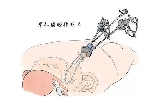 腹腔镜手术漫画图片