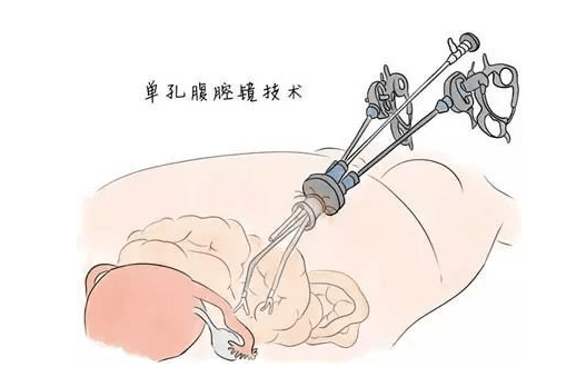 告诉您:腹腔镜是一个手术器械,通过镜头,光导纤维,光源,帮助镜子和