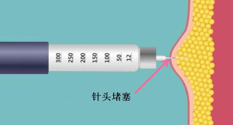 小针头,大风险——您的胰岛素针头一次一换吗
