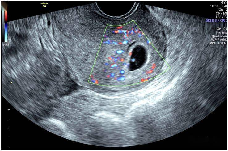 警惕检出宫内妊娠时要考虑异位妊娠发生的可能