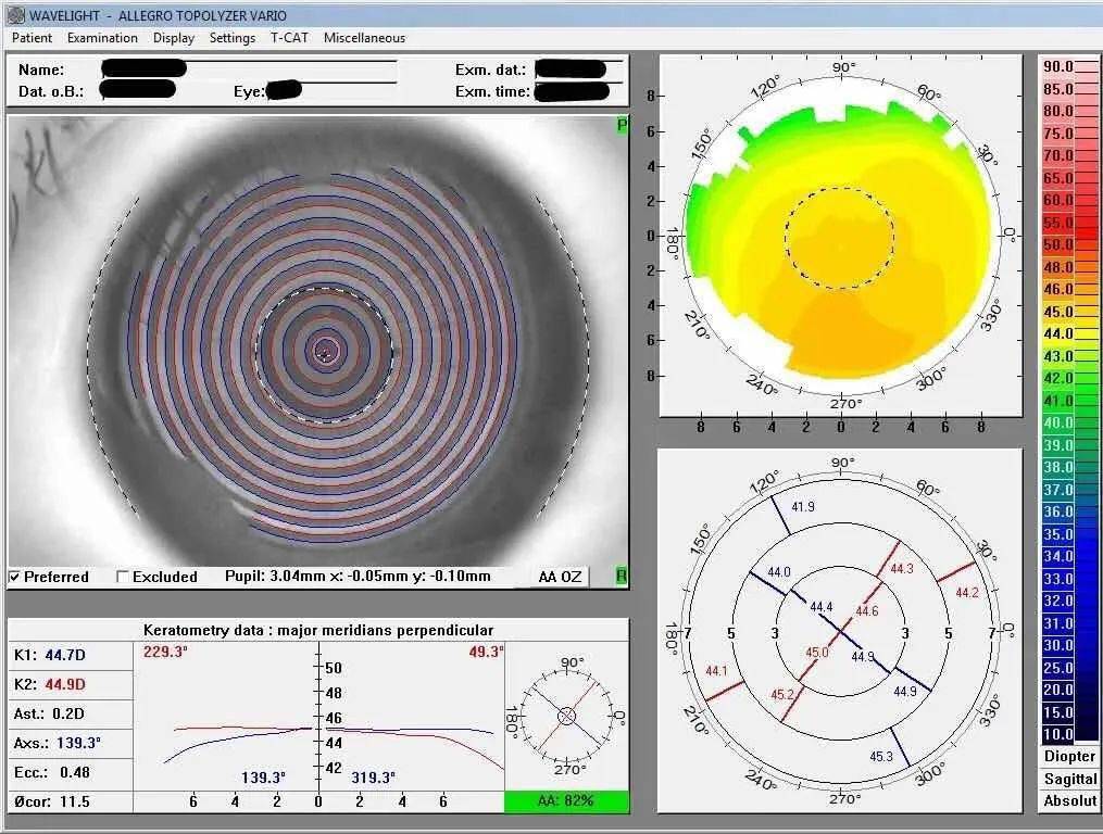 角膜地形图(topolyzer)术前检查