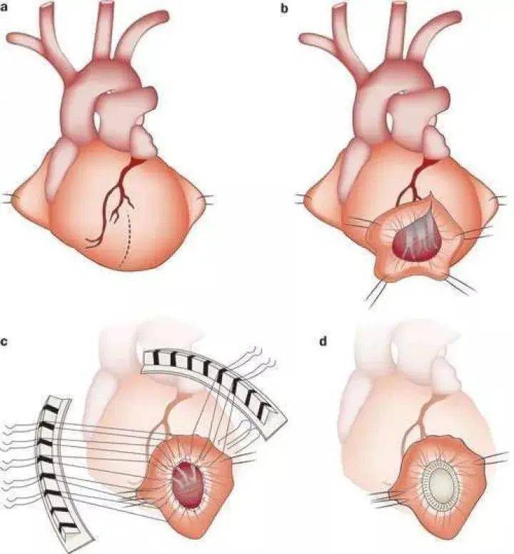 乳内动脉搭桥图解图片