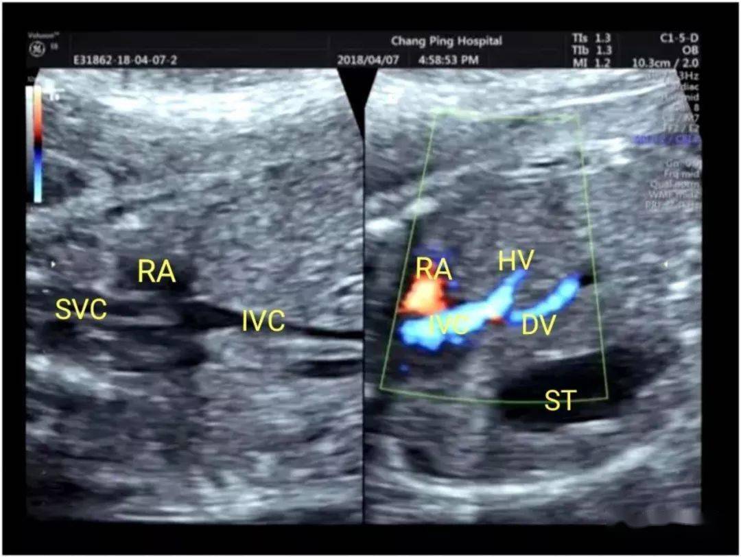 超声典型病例胎儿法洛四联症合并右位主动脉弓
