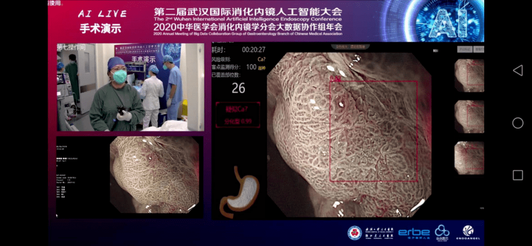 影像内镜精灵endoangel内镜医师的第三只眼消化内镜人工智能解决方案