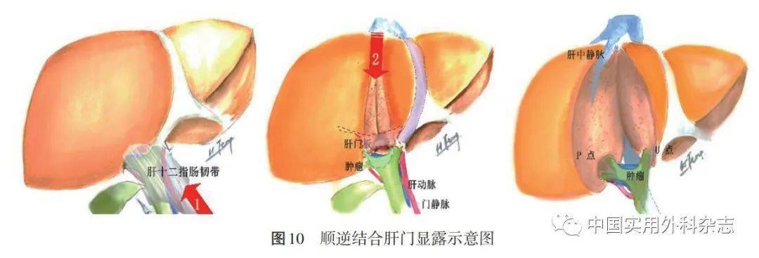 肝门在哪个位置图片图片