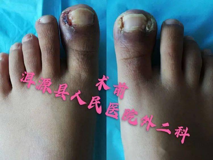 治疗踇趾嵌甲型甲沟炎,还要拔甲吗?