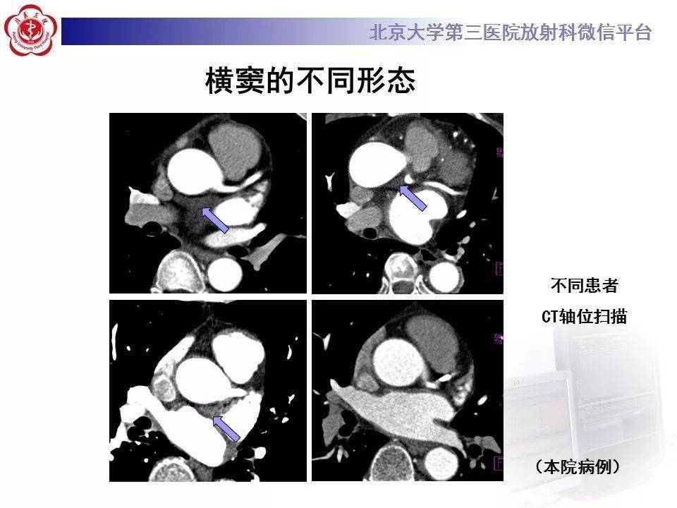 影像精美解剖丨心包竇及心包隱窩解剖建議收藏