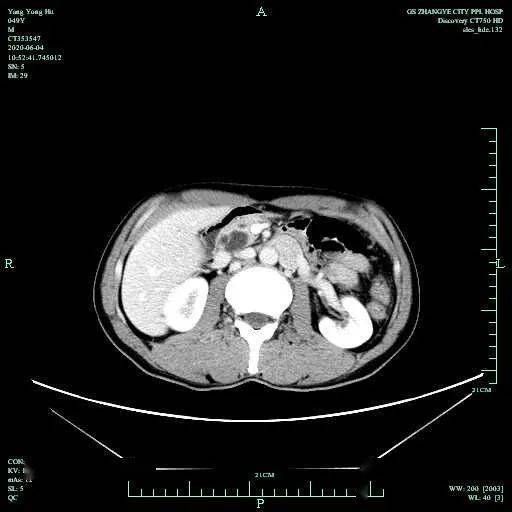 術前ct43歲的張先生,近五年來因反覆發生急性胰腺炎在當地醫院多次