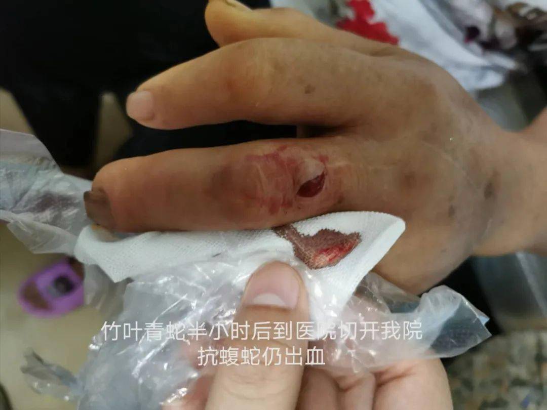 广西医科大学第一附属医院入夏以来,毒蛇咬伤事件屡屡发生