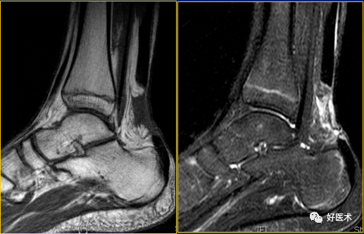 跟腱断裂mri图片