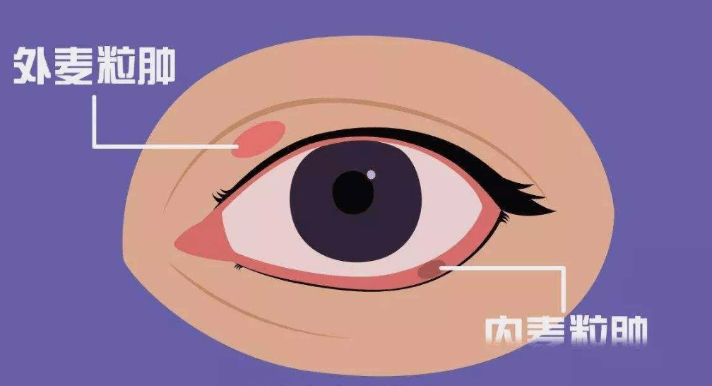 為什麼會長針眼這5個原因你真的注意過嗎