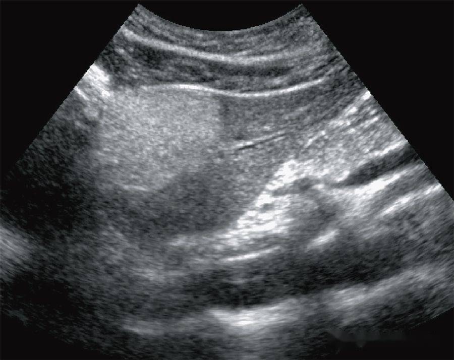 【超声随响】第05期 肝细胞腺瘤 hepatic adenoma