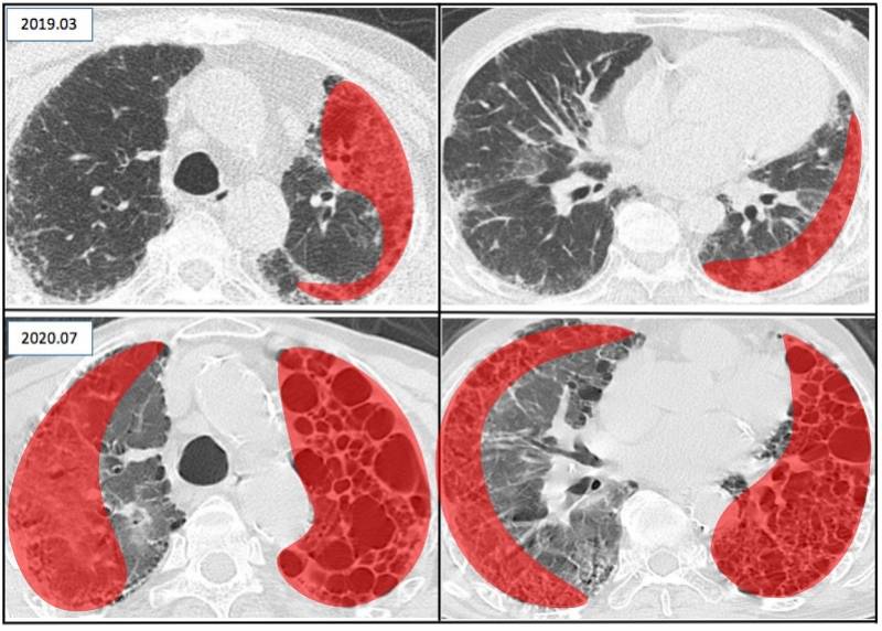 肺纤维化病灶图片