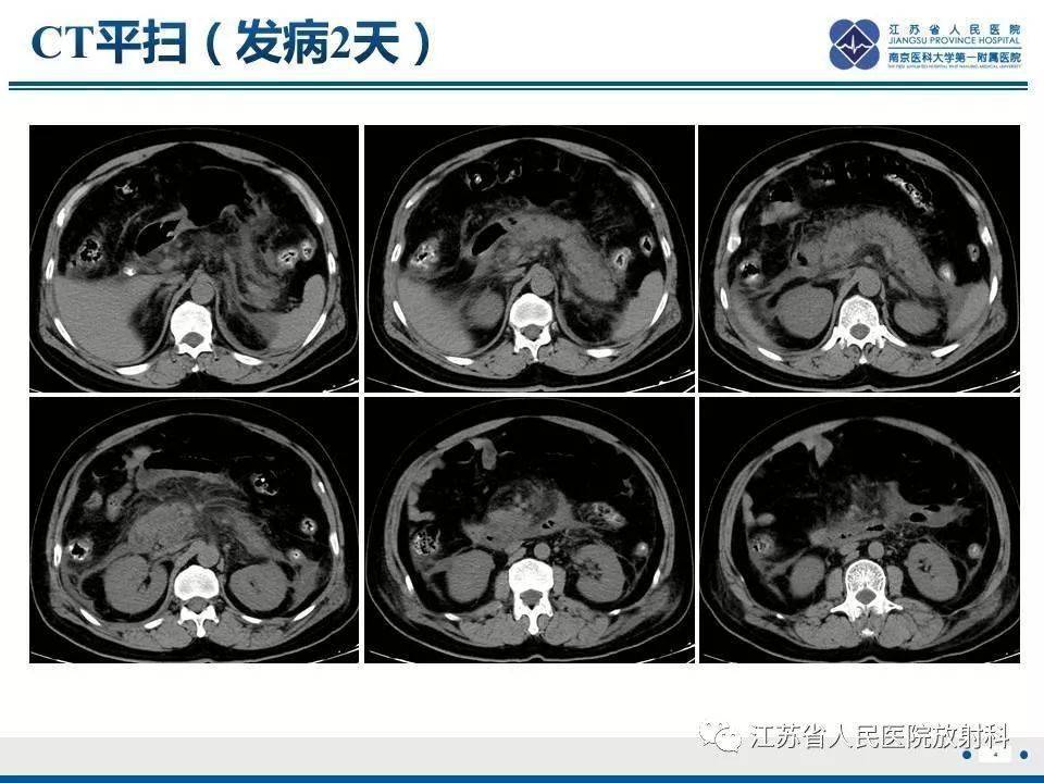 精彩病例 | 壞死性胰腺炎