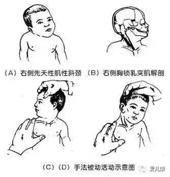 宝宝脖子上怎么长了个硬包警惕可能是肌性斜颈