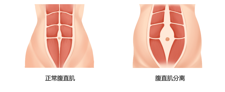 两次及以上剖宫产的产妇腹直肌分离发生率高达90