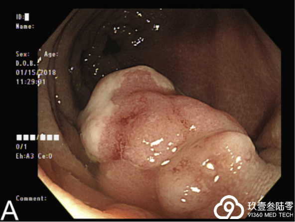 结肠菜花样肿物图片