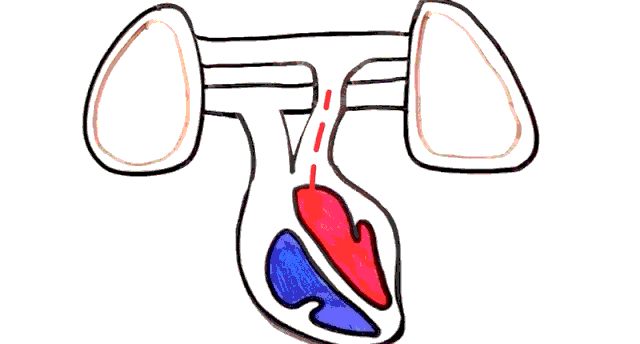 肺动脉高压是进展性疾病,到了后期病人会发展成为右