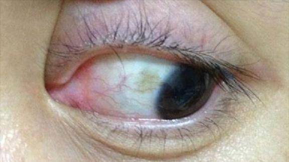 疫情期间在家发现眼睛上有黄色的斑这个有必要去医院吗