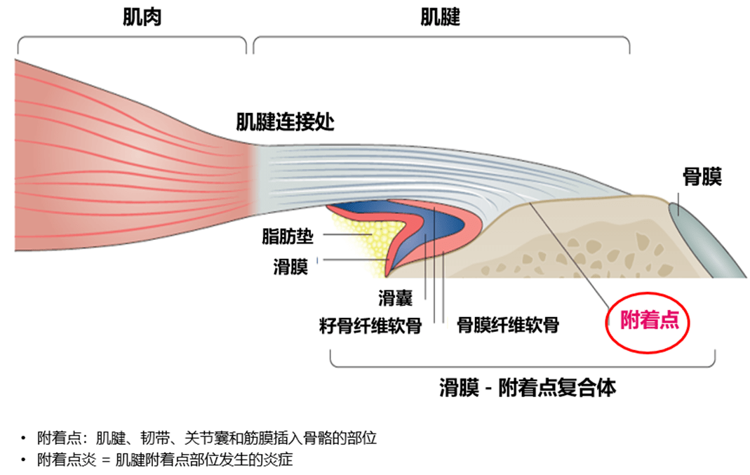 強直糾纏不休的附著點炎究竟是怎麼一回事