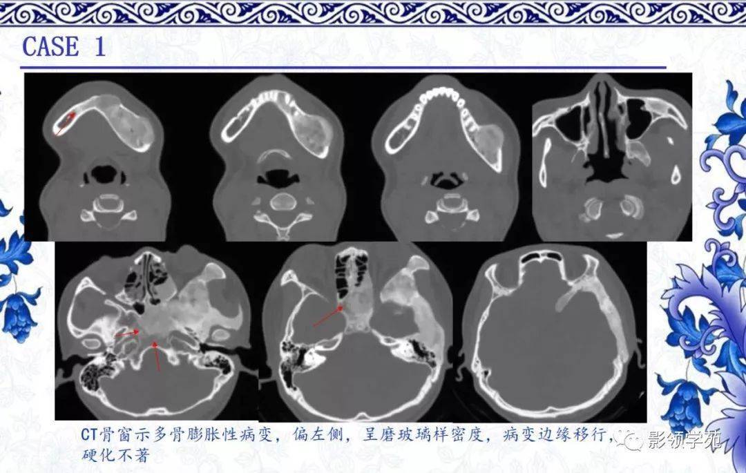 經典回顧纖維結構不良的影像表現