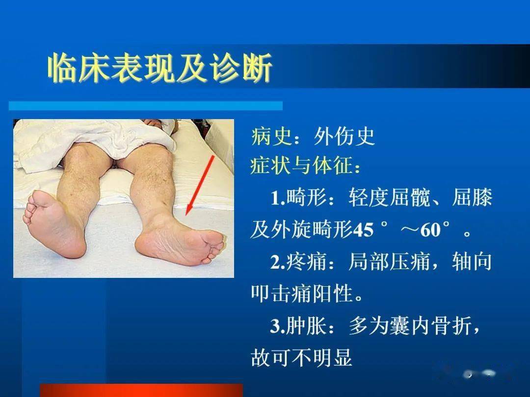 股骨颈骨折影像表现
