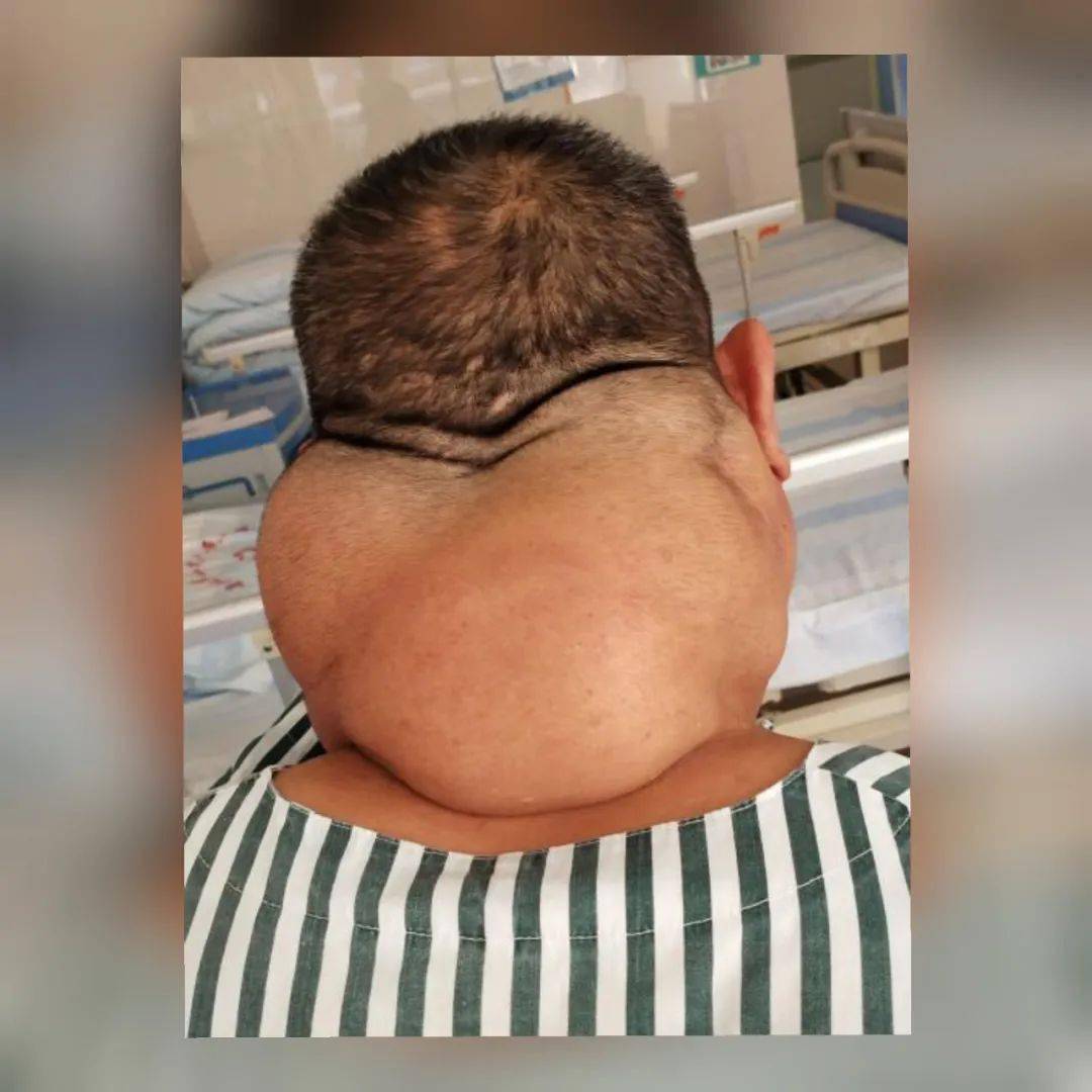 慎点!每天喝酒1斤半,男子颈部一次取出了2斤重的