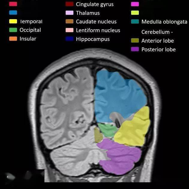 gyrus 扣带回thalamus 丘脑caudate nucleus 尾状核lentiform nucleus