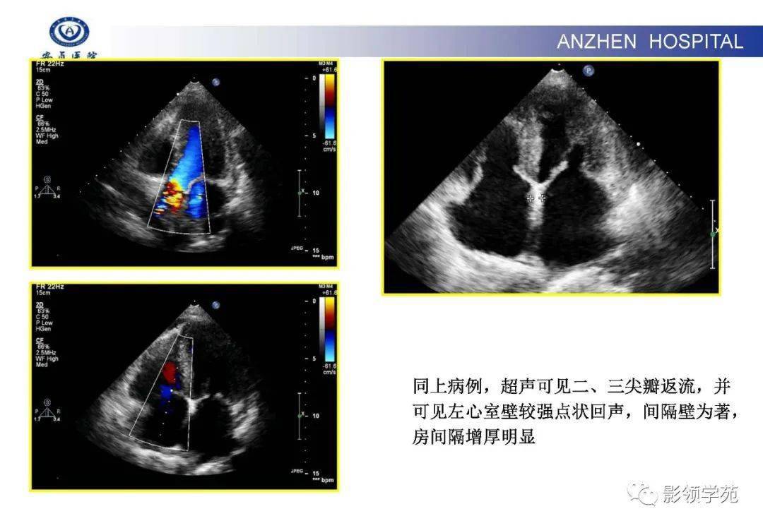 cmr对肥厚型心肌病的鉴别诊断