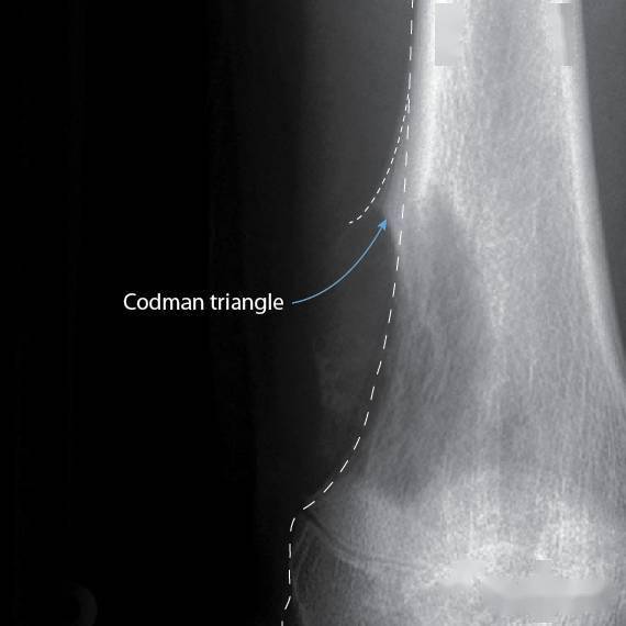 骨膜反应codman三角图片