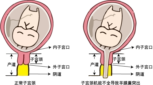 经过一系列检查,婷婷被诊断为"宫颈机能不全".