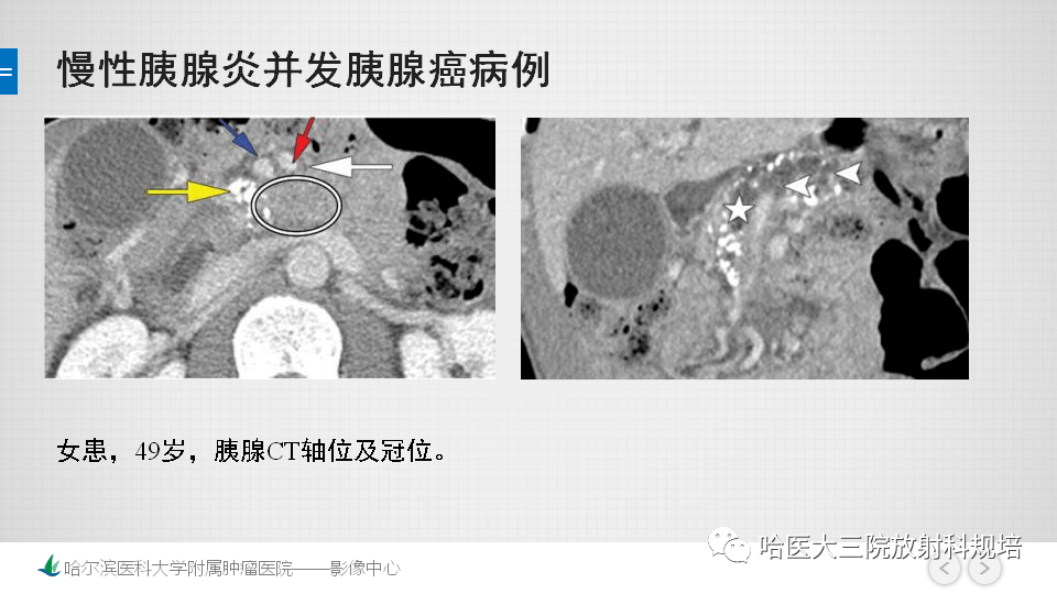 慢性胰腺炎与胰腺癌的影像学鉴别诊断思路