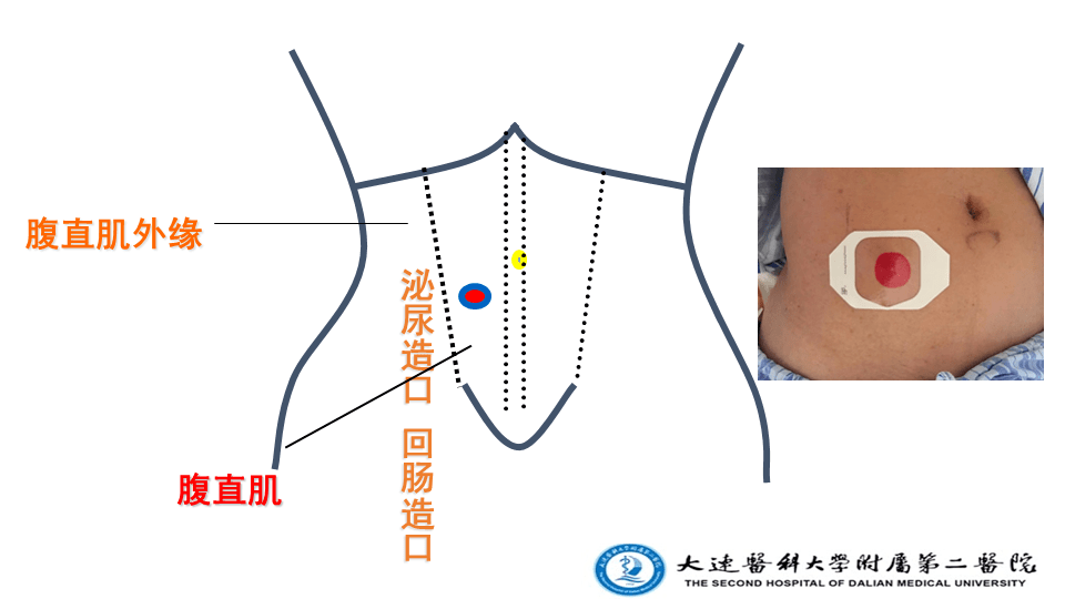膀胱造瘘位置图片