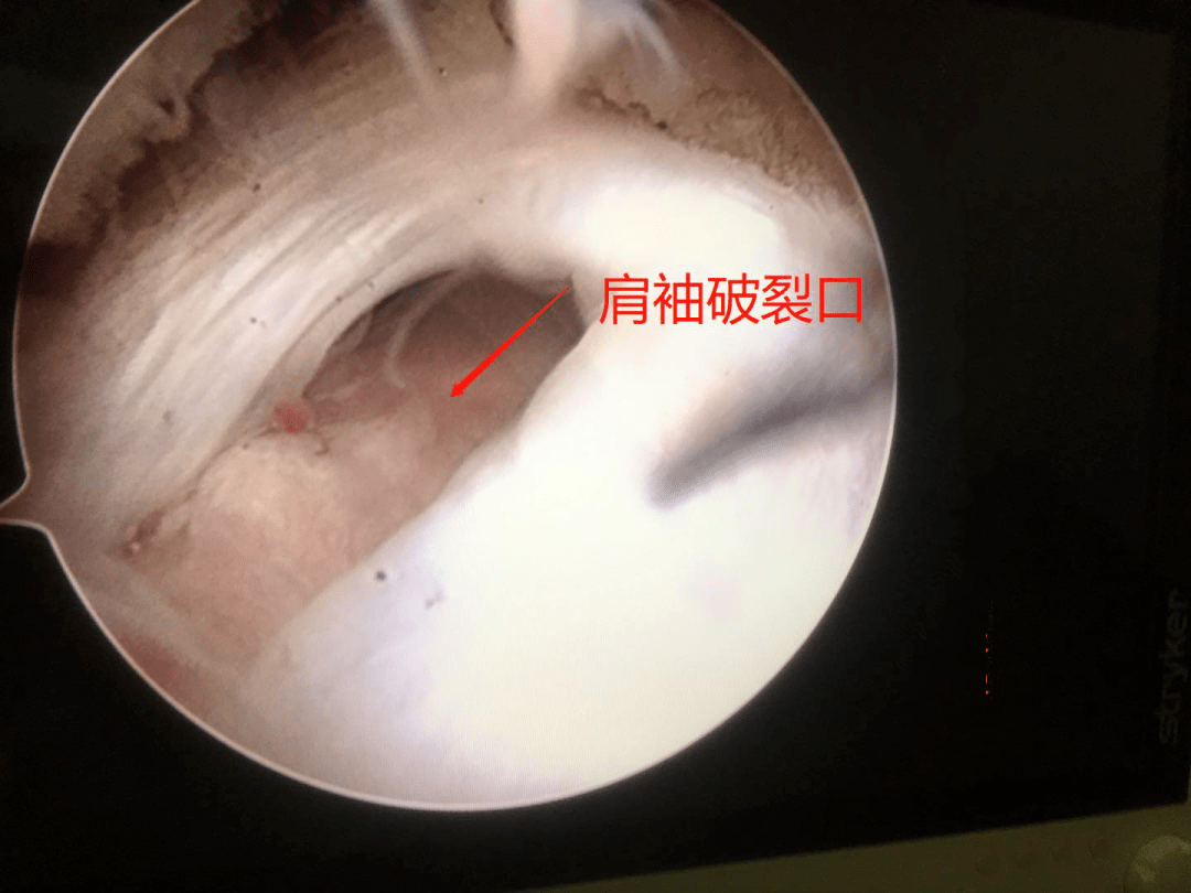 医疗技术我院运动医学团队成功实施肩关节镜下肩峰成形肩袖损伤修补术