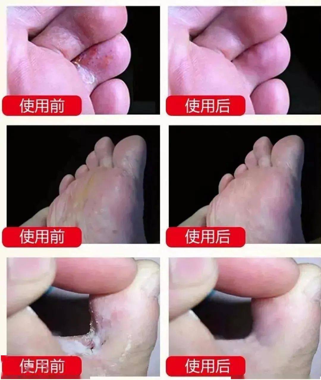 干脚气治疗方法图片