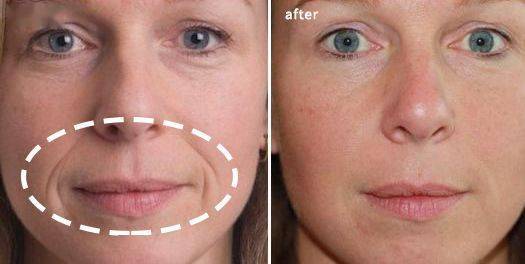 法令纹,眉间纹又凶又老!贴上它,睡走"三八"脸!胜过10次除皱针!