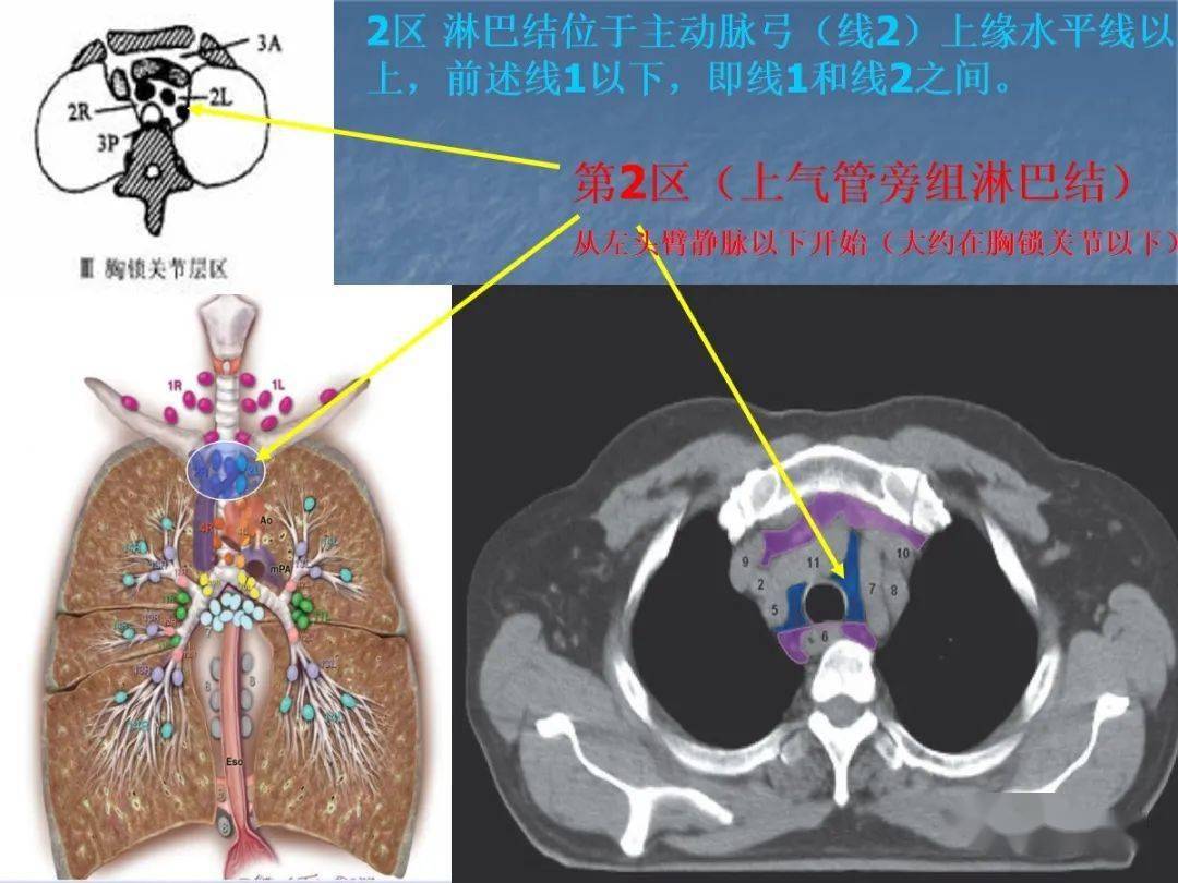 肺淋巴结分组图片